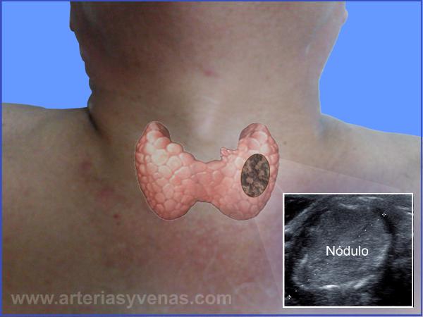 Día Mundial De La Tiroides, ¿Cómo Se Determina Si Su Nódulo Es ...
