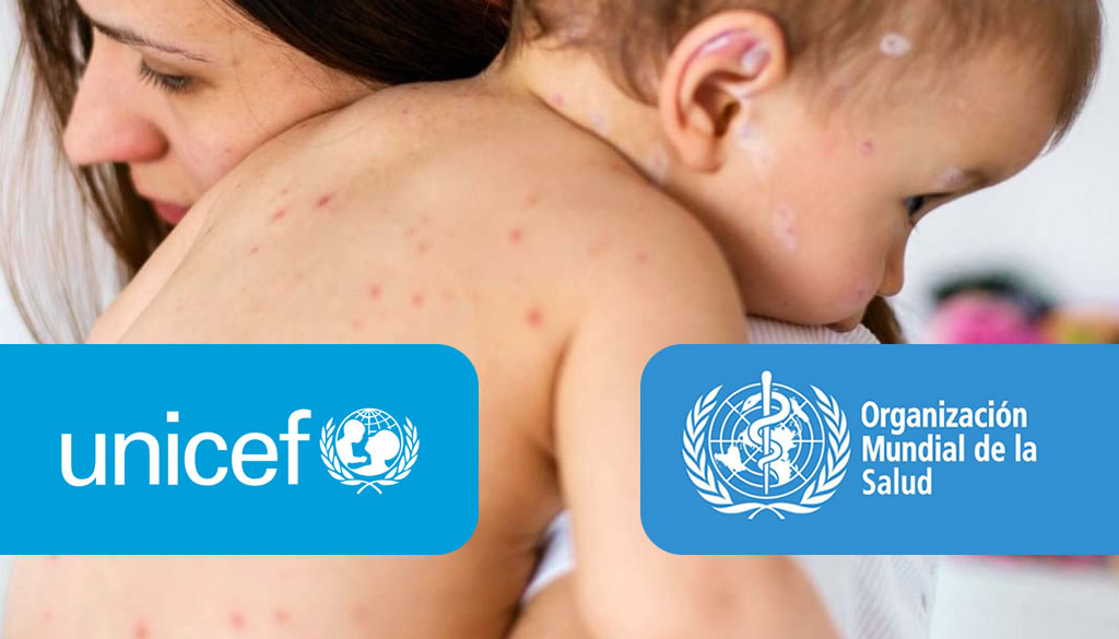 Alertan sobre aumento en brotes de sarampión por falta de inmunización 